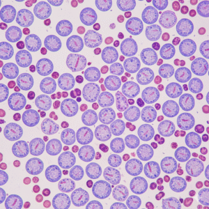 Acute Leukemia Comprehensive Panel Flowcytometry